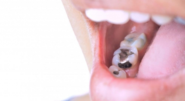 White Fillings for Front Teeth: Are They Right for You?
