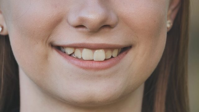 Overlapping Teeth Correction: Step-by-Step Guide to a Perfect Smile