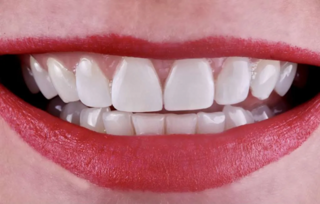 Composite Veneers for Teens: What Parents Should Know